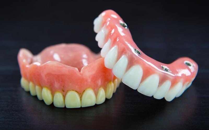 Difference Between Dentures and All on 4 Implant Bridge